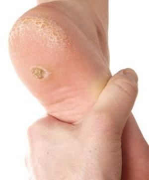 Plantar wart removal