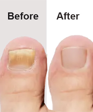 Fungal Toenail Treatment